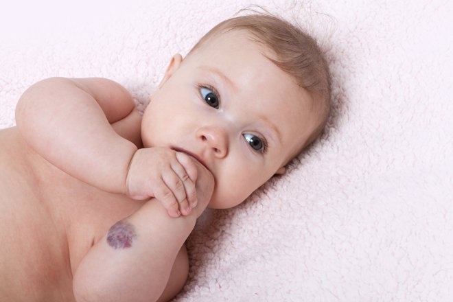 Hemangiomas en la piel de los niños